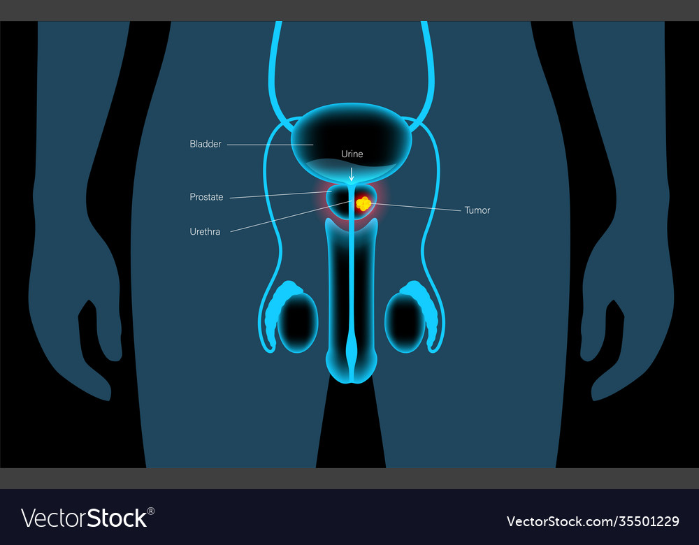 Prostate Cancer Concept Royalty Free Vector Image