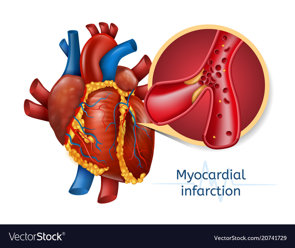 Myocardial Infarction D Realistic Heart Vector Image