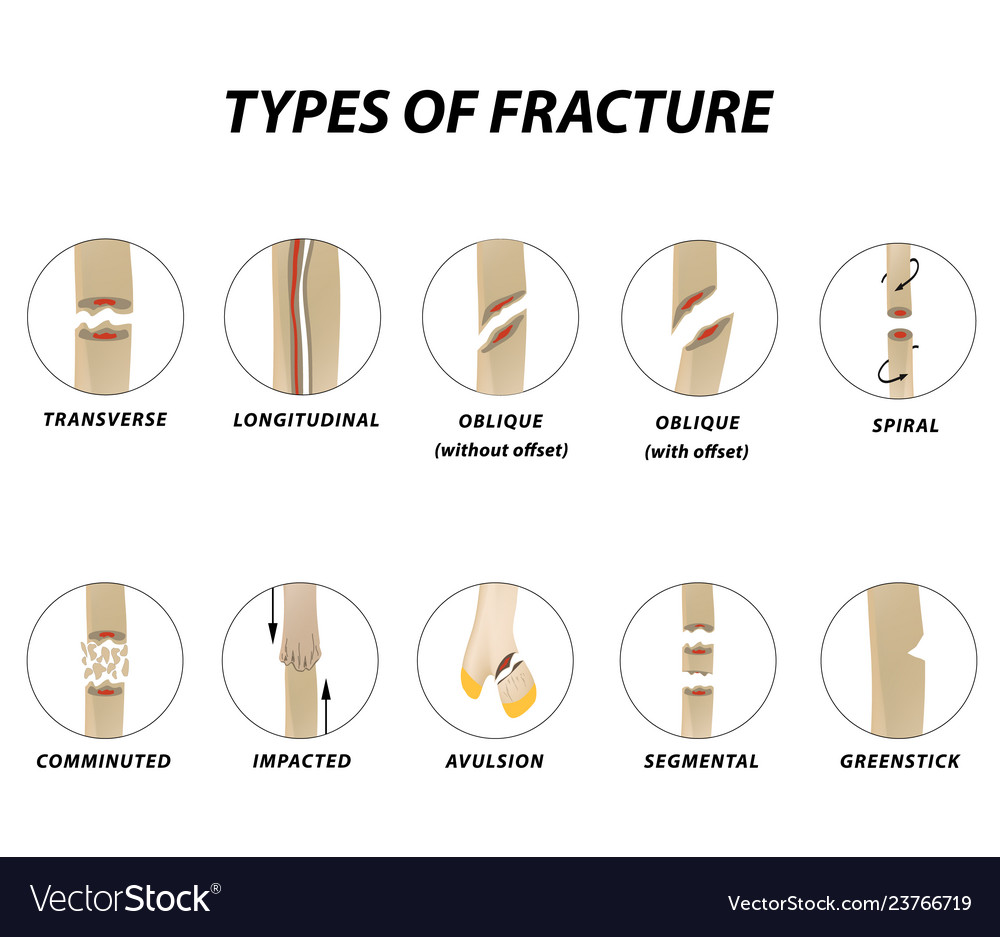 Types Of Fracture Fracture Bone Set Infographics Vector Image