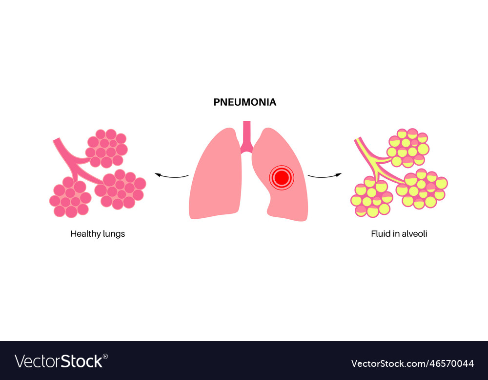 Pneumonia infection poster Royalty Free Vector Image