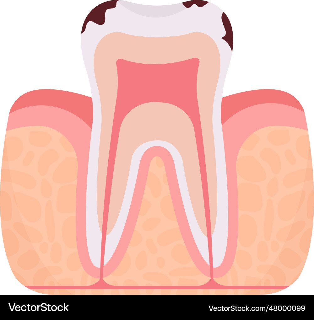 Caries tooth problem Royalty Free Vector Image