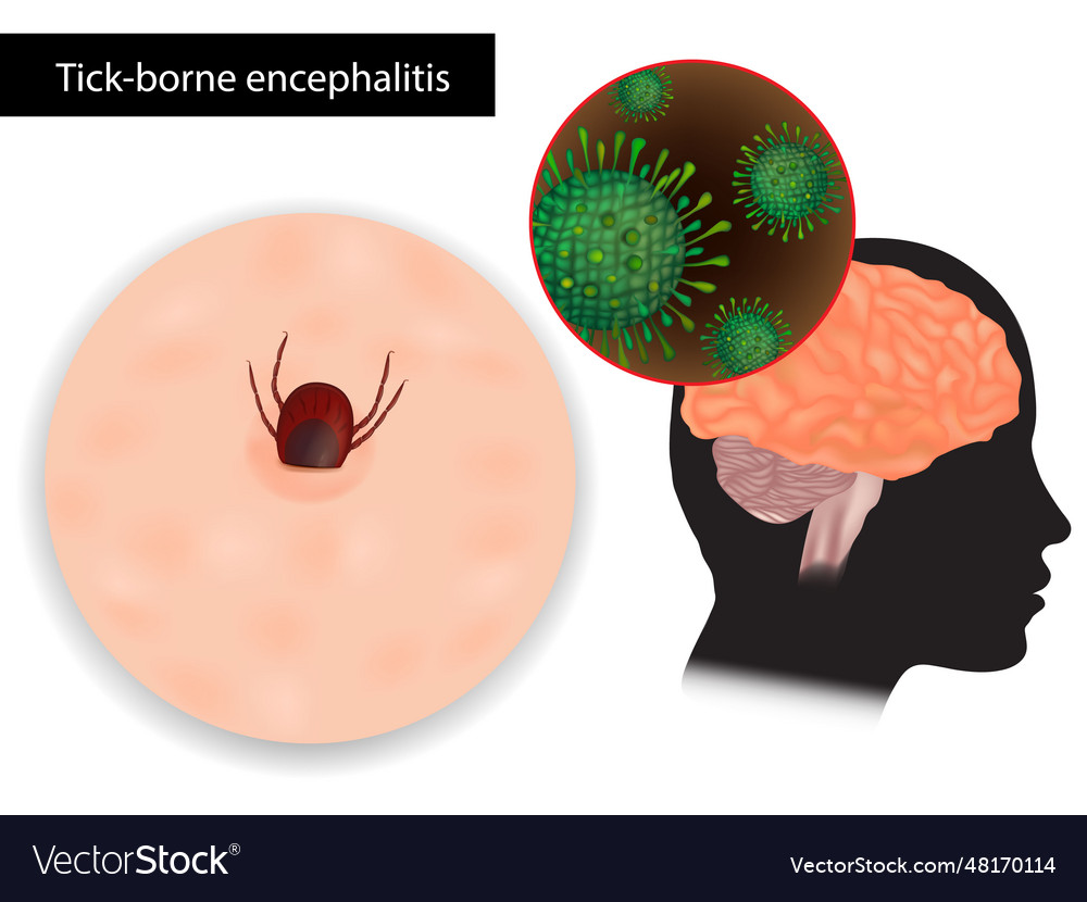 Tick-borne encephalitis viral infectious disease Vector Image