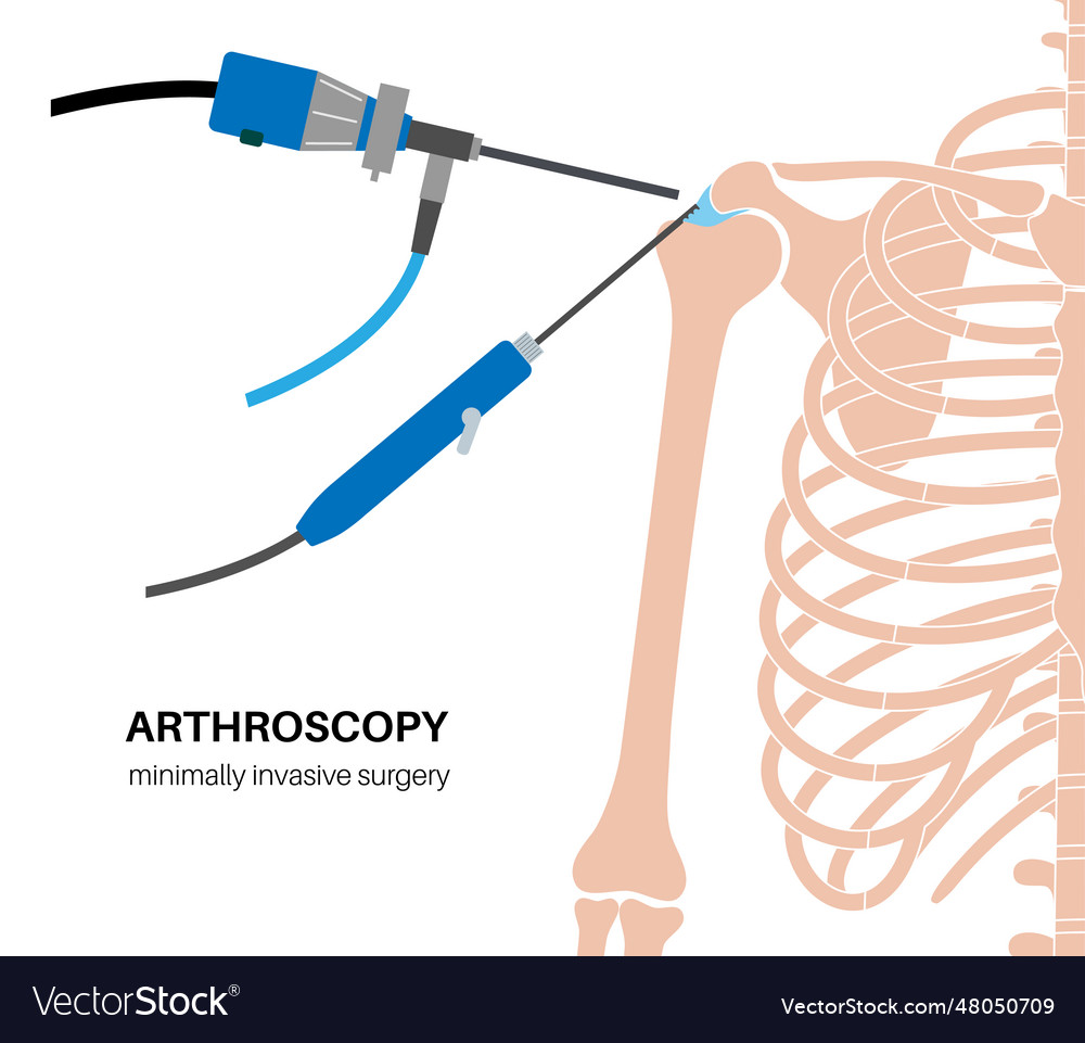 Shoulder arthroscopy poster Royalty Free Vector Image