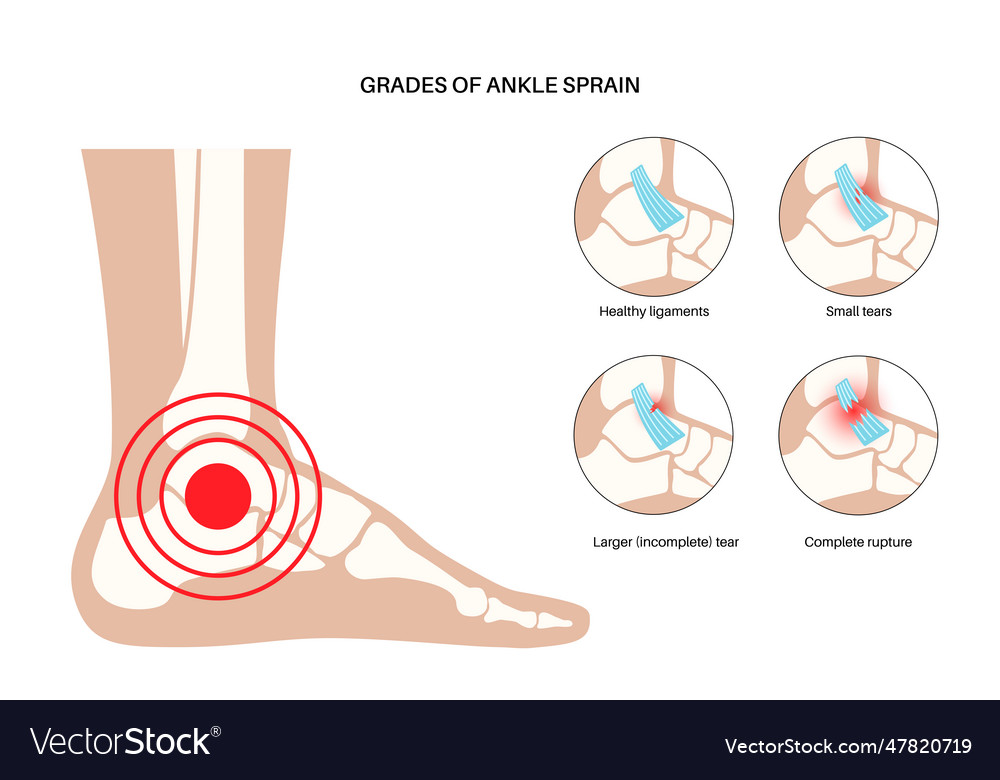 Sprained ankle injury Royalty Free Vector Image