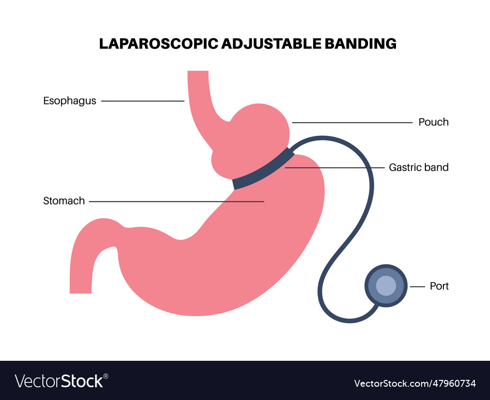 Gastric band poster Royalty Free Vector Image - VectorStock