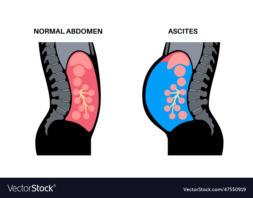 Ascites disease poster Royalty Free Vector Image