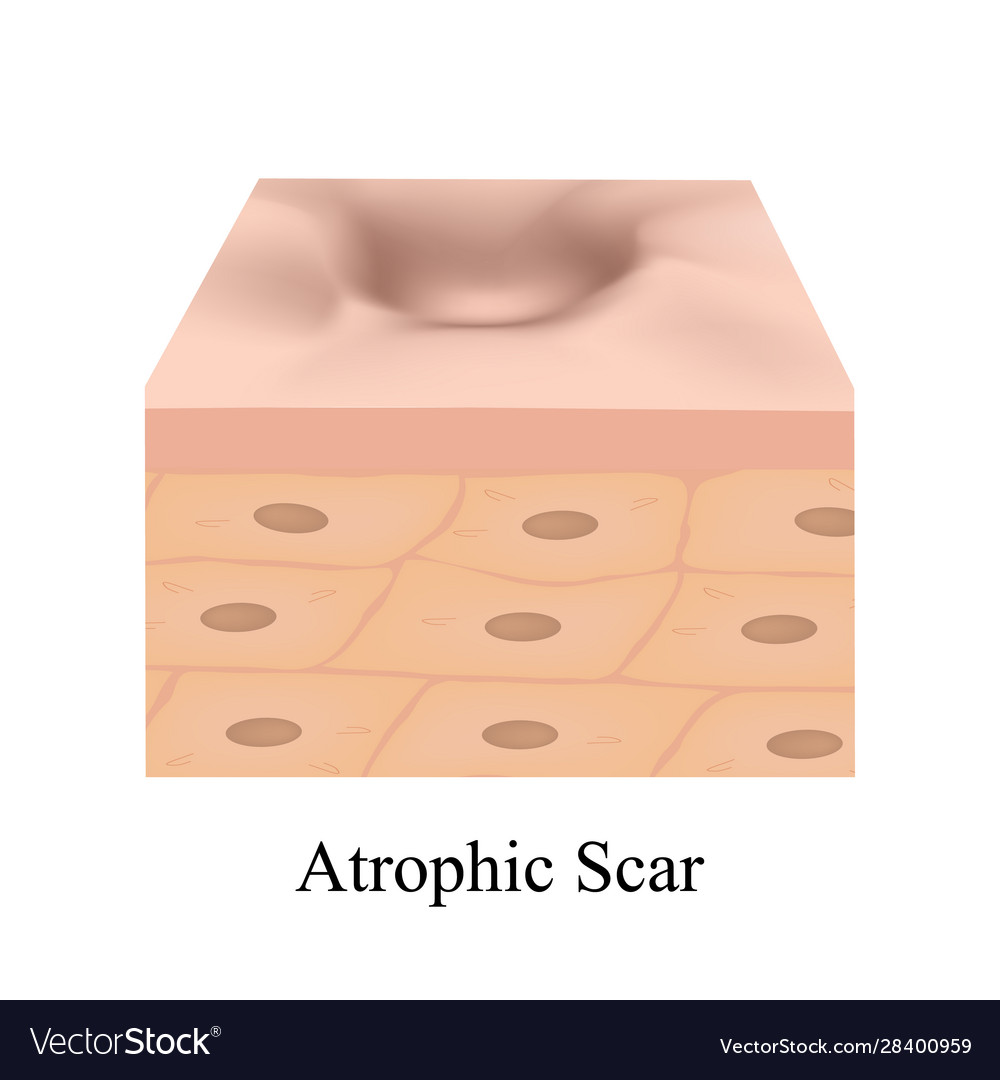 Atrophic scars acne scar the anatomical Royalty Free Vector