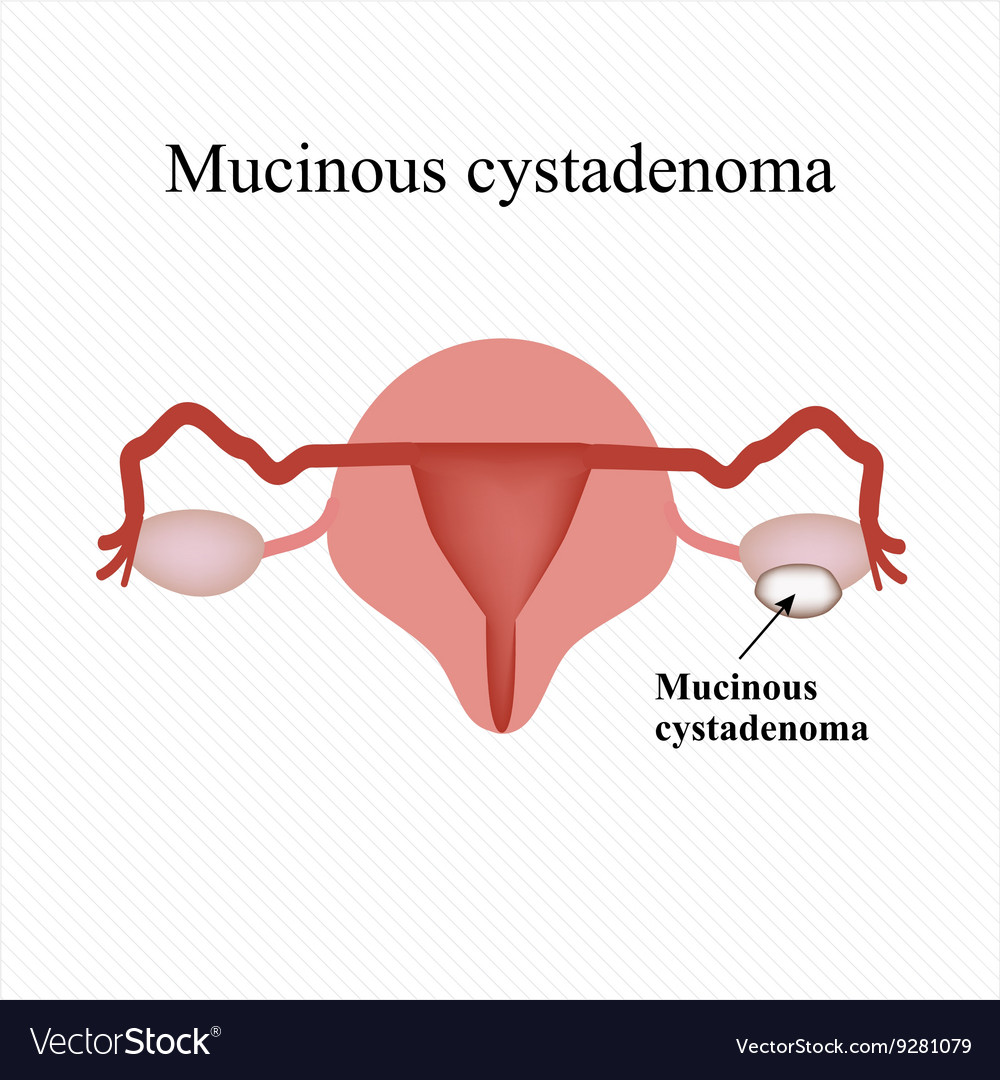 Mucinous Cyst On The Ovary Cystadenoma Royalty Free Vector