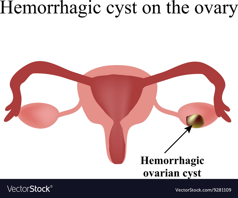 Hemorrhagic Cyst On The Ovary Ovary Infographics Vector Image 6245