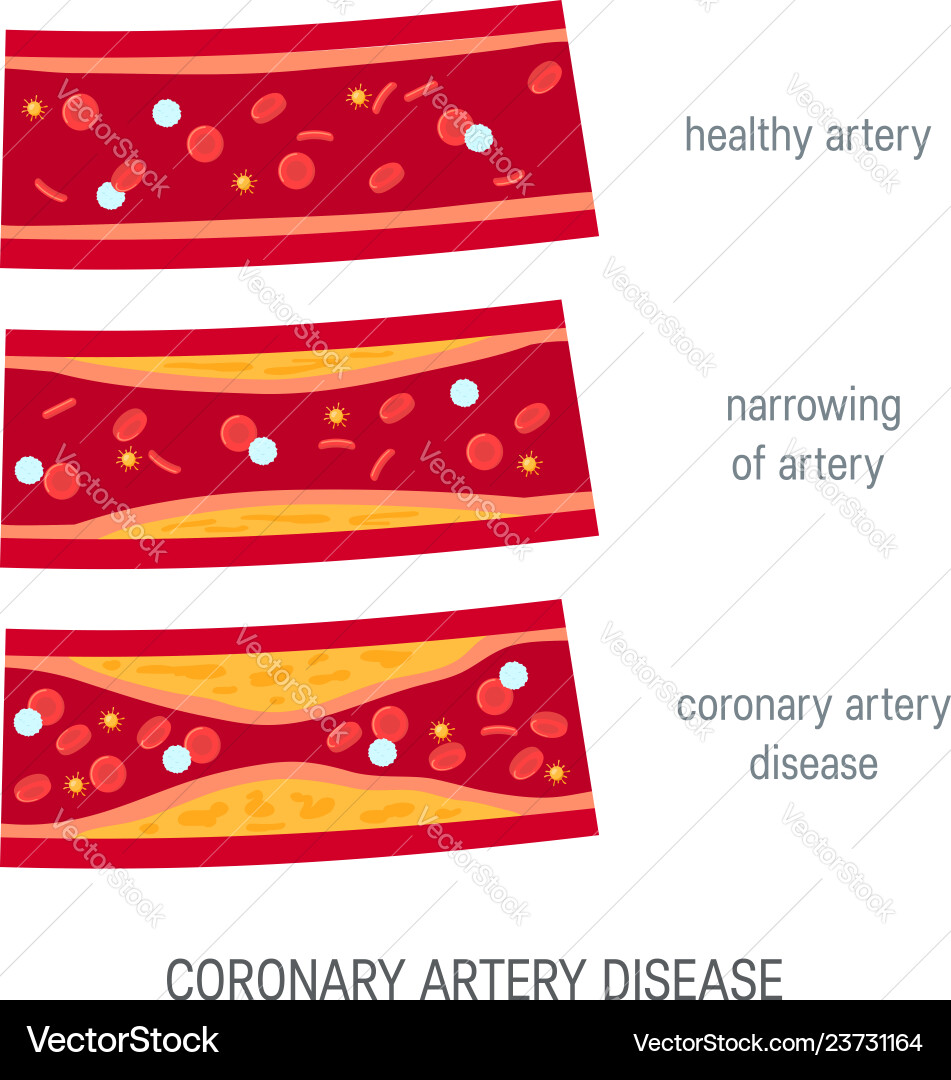 Coronary Artery Disease Concept In Flat Style Vector Image