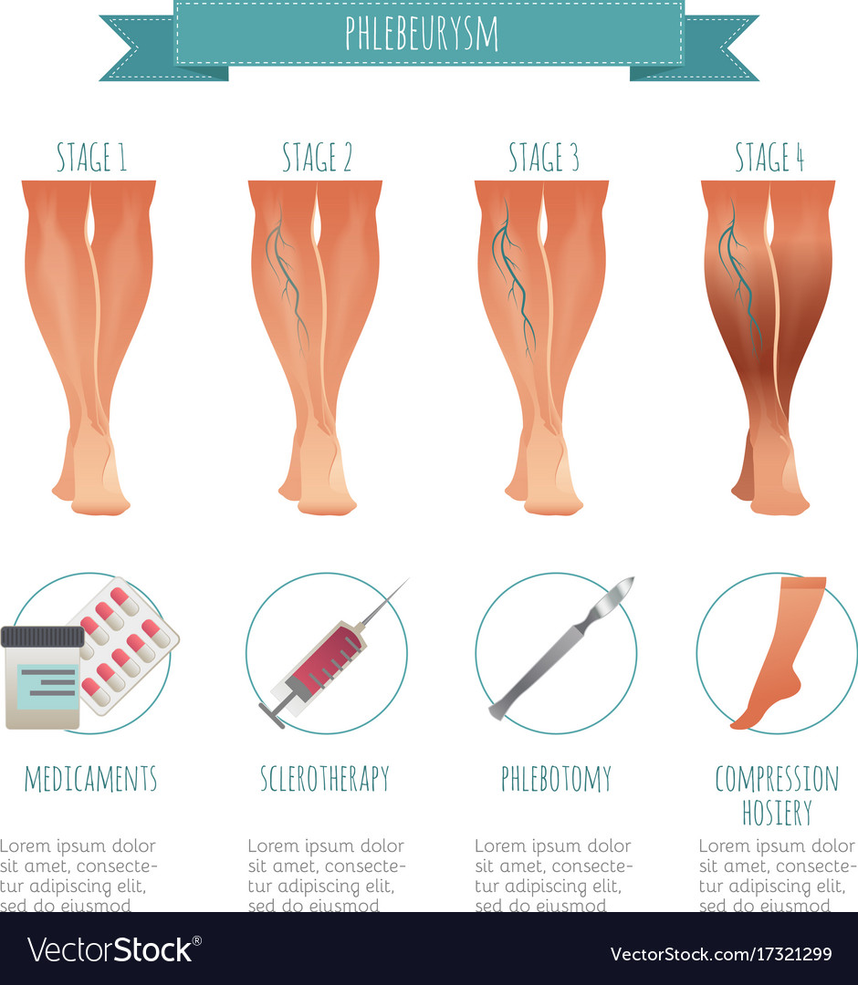 Phlebology infographic treating varicose veins Vector Image