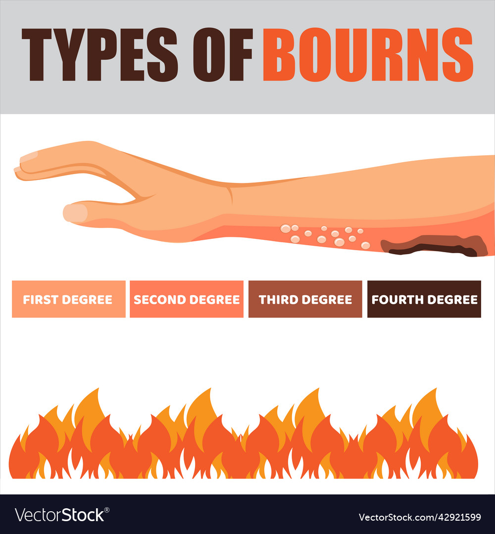 Skin burn injury treatment and stages infographic Vector Image