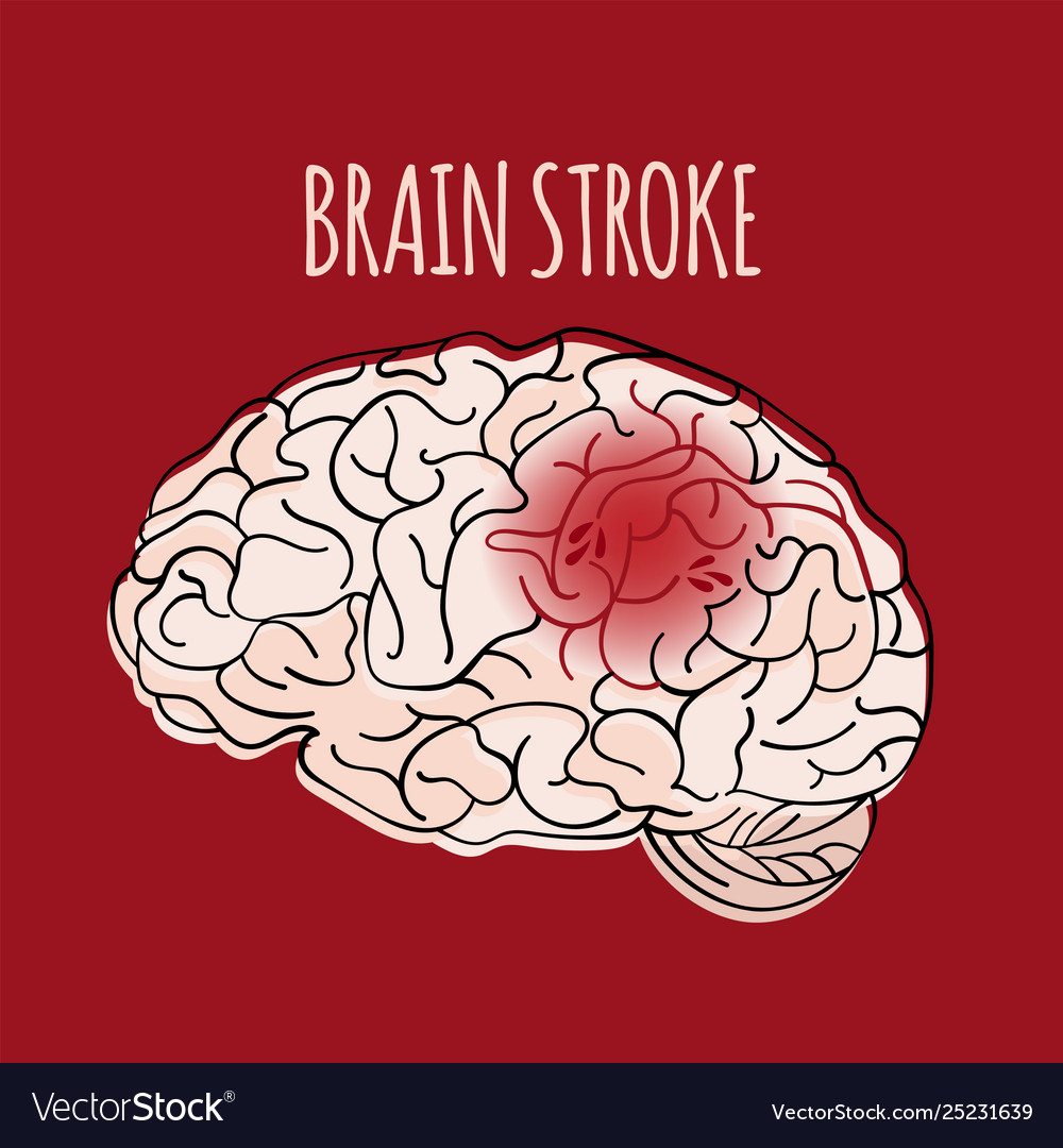 Brain stroke insult medicine health Royalty Free Vector