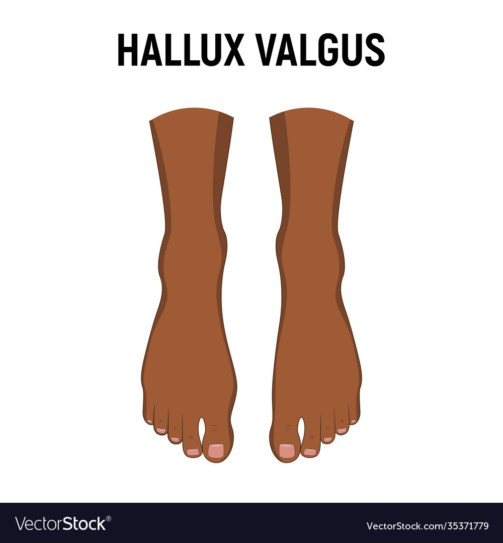 Hallux valgus problem Royalty Free Vector Image