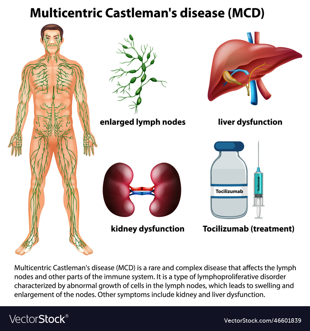 Multicentric castlemans disease mcd infographic Vector Image