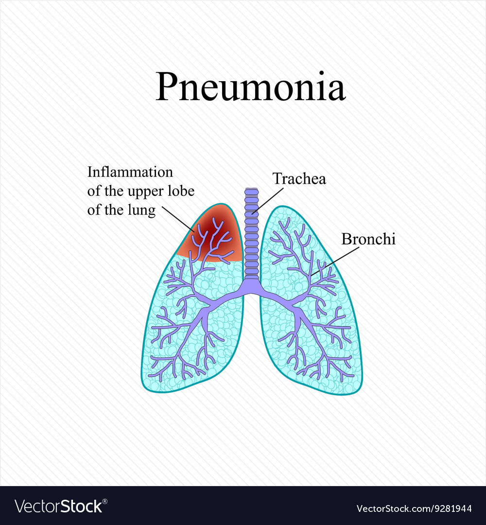 Pneumonia the anatomical structure of human Vector Image