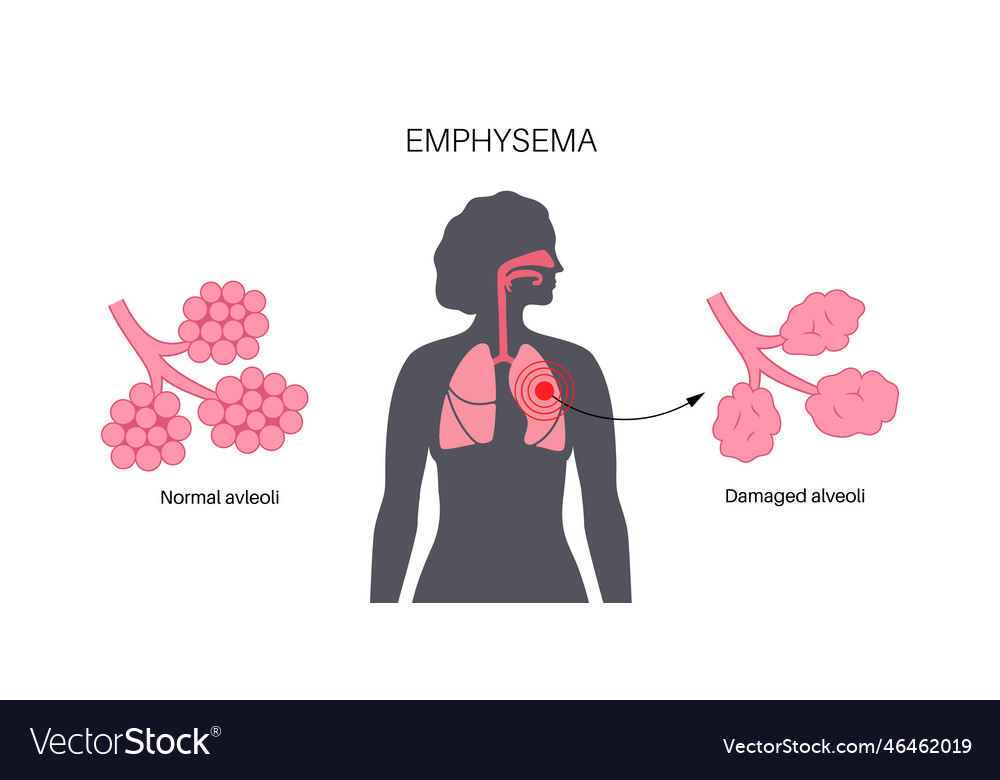 Emphysema anatomical poster Royalty Free Vector Image