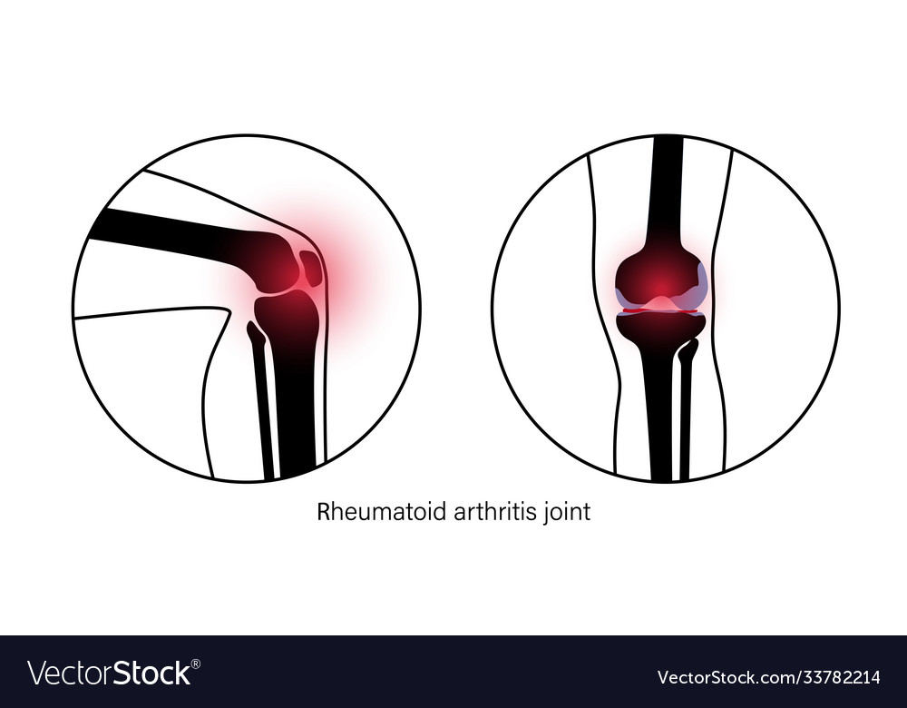 Arthritis in knee joint Royalty Free Vector Image