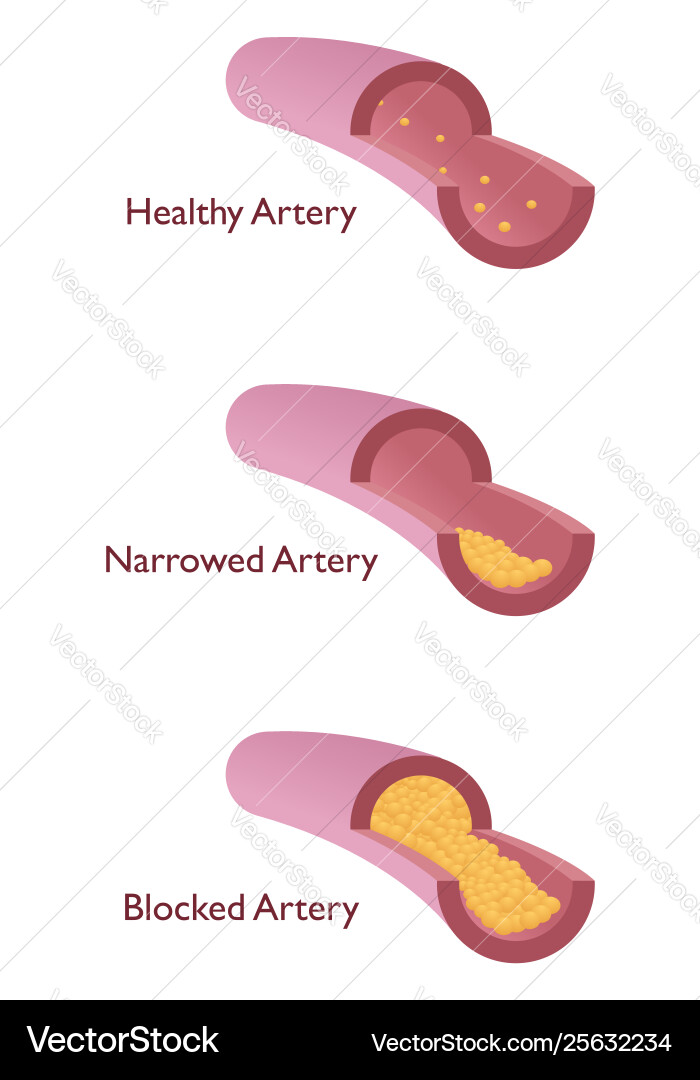 Atherosclerosis Royalty Free Vector Image Vectorstock