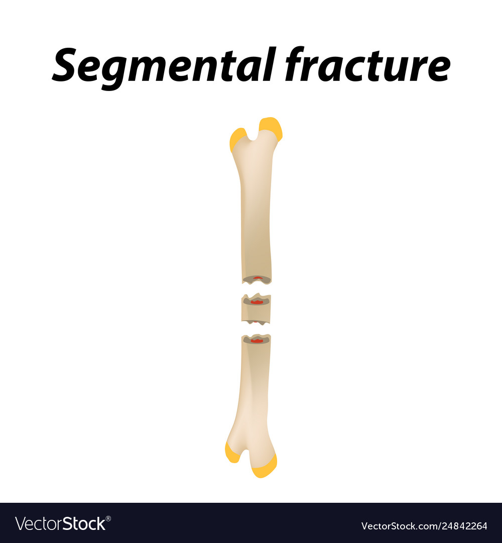 Segmental fracture bone infographics Royalty Free Vector