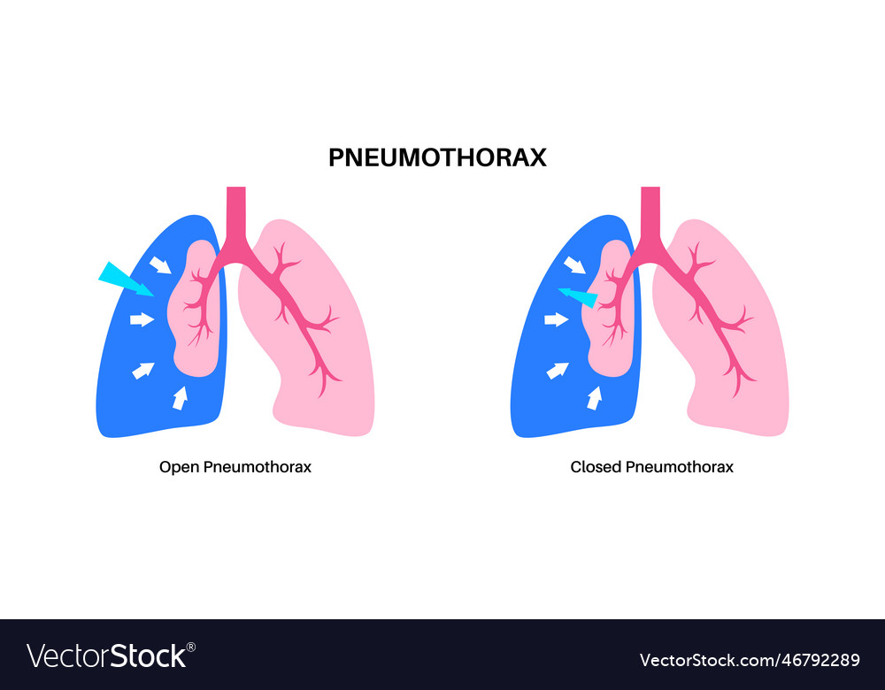 Pneumothorax anatomical poster Royalty Free Vector Image