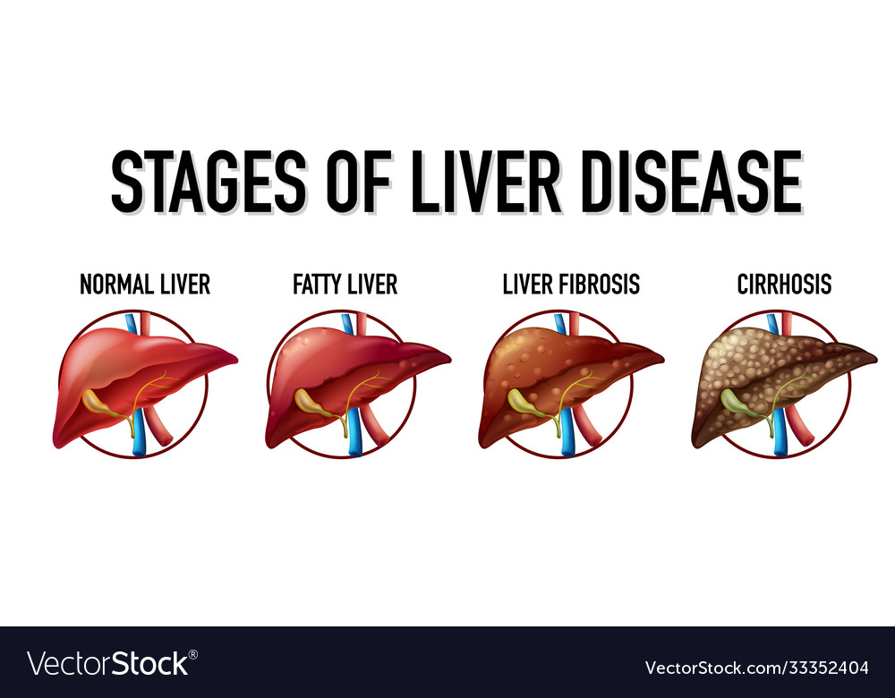 Stages liver disease Royalty Free Vector Image