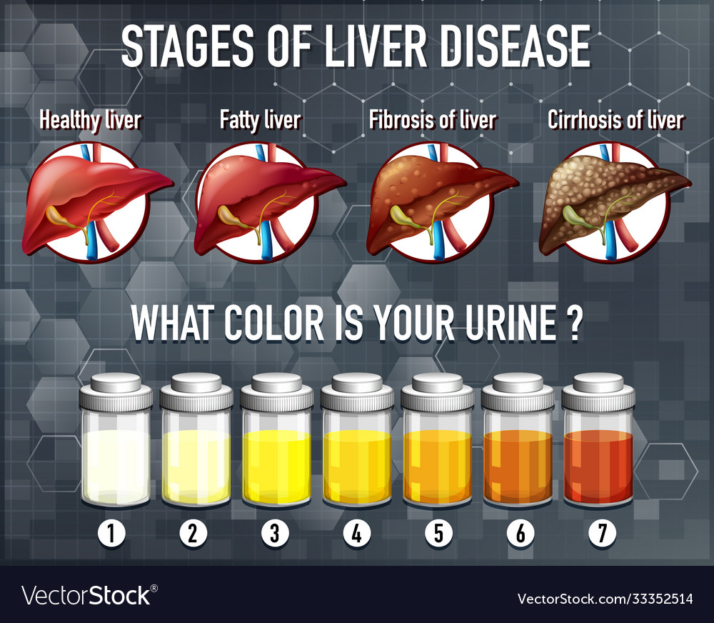 Stages liver disease Royalty Free Vector Image