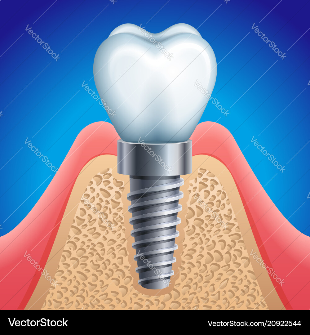 Dental implant icon Royalty Free Vector Image VectorStock