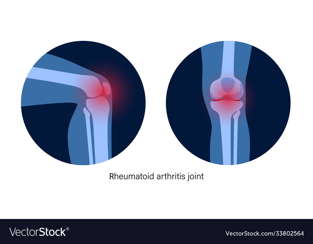 Arthritis in knee joint Royalty Free Vector Image