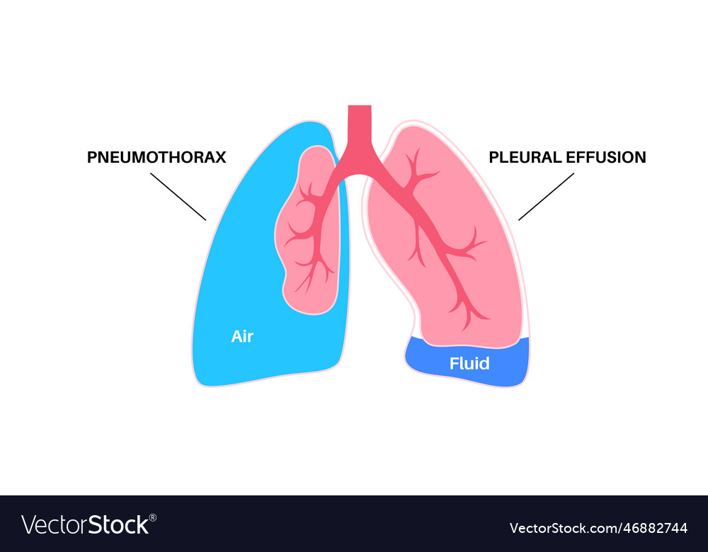 Pleural Effusion And Pneumothorax Royalty Free Vector Image 7087