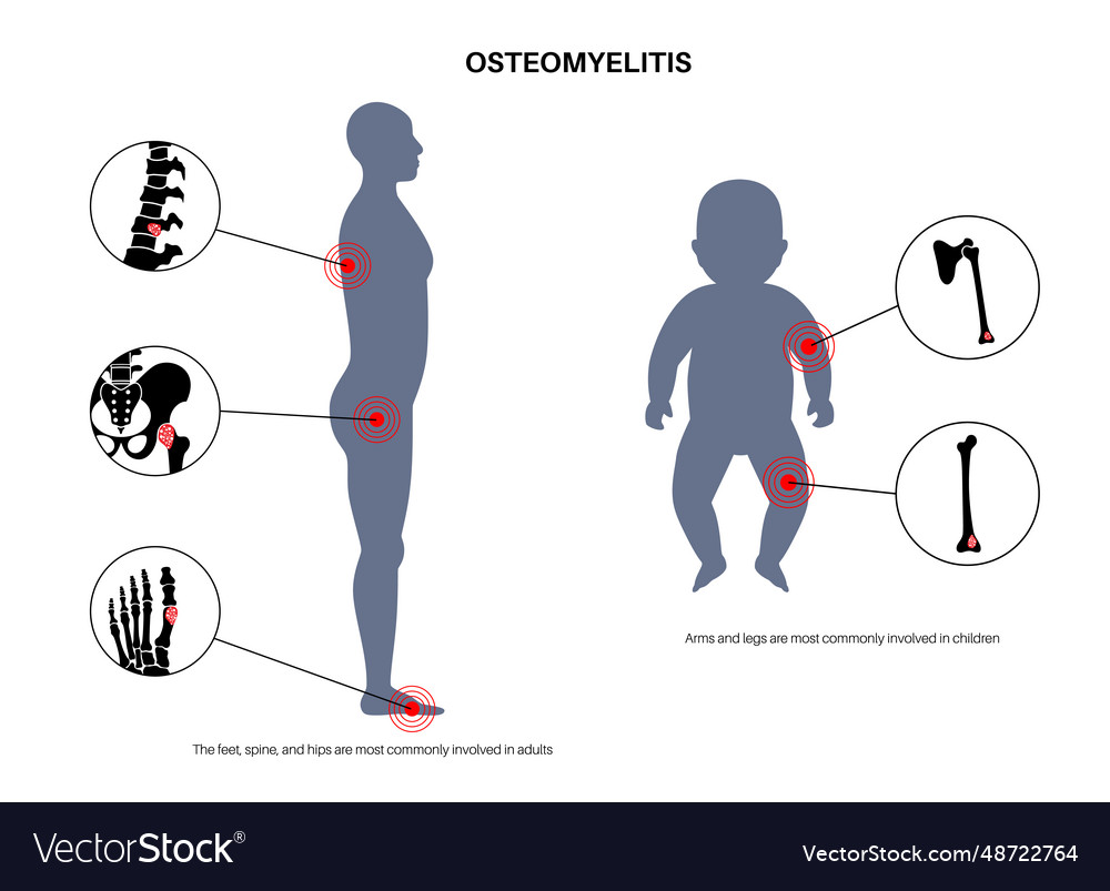 Osteomyelitis disease poster Royalty Free Vector Image