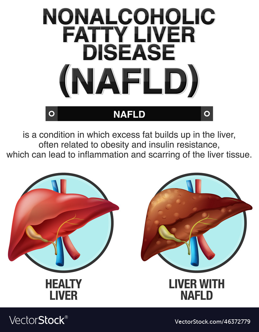 Nonalcoholic fatty liver disease Royalty Free Vector Image