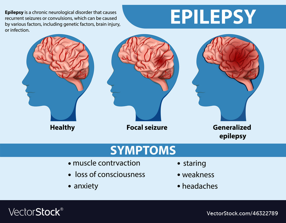 Informative poster of epilepsy Royalty Free Vector Image