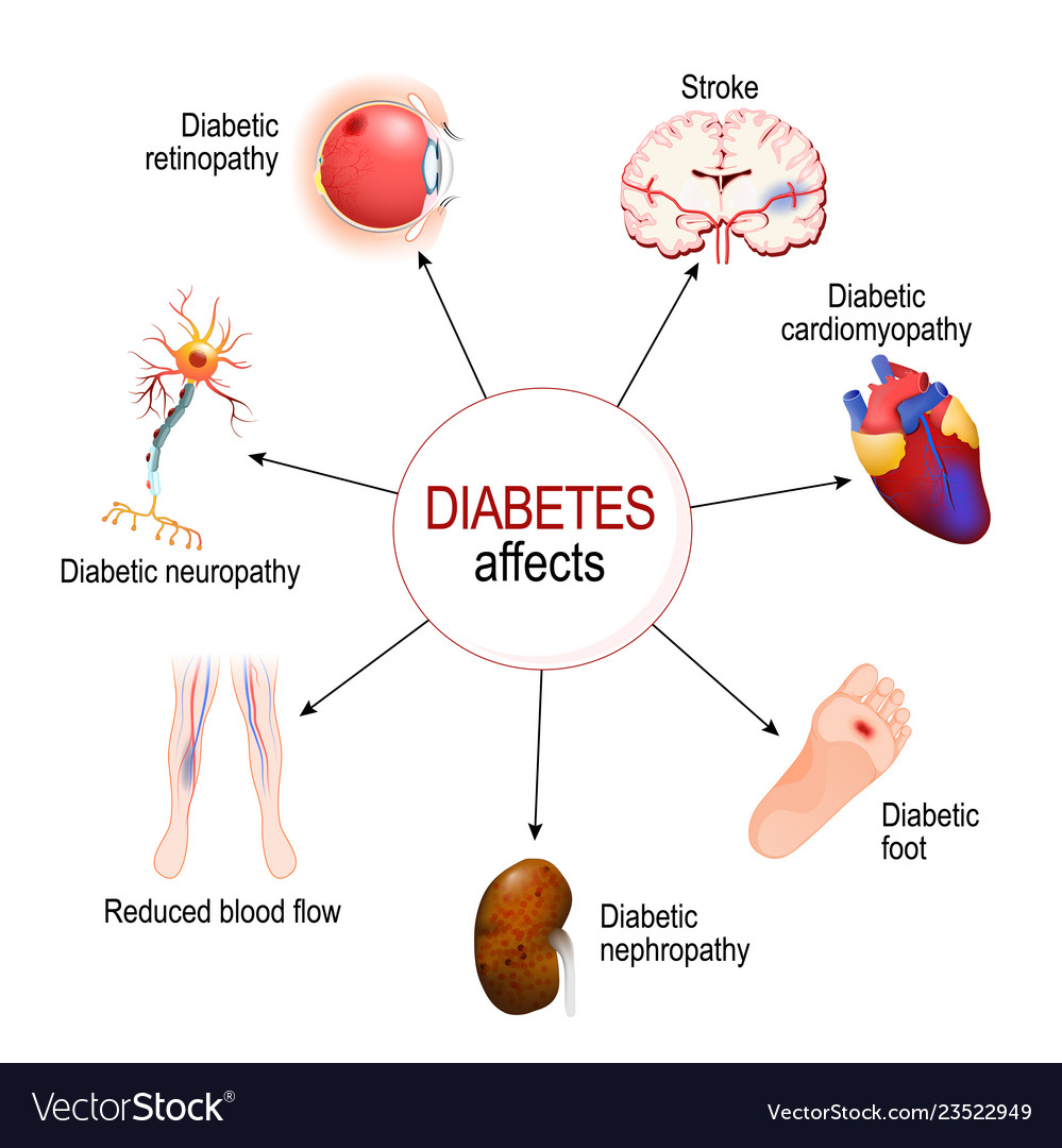 Diabetes Affects Complications Diabetes Royalty Free Vector