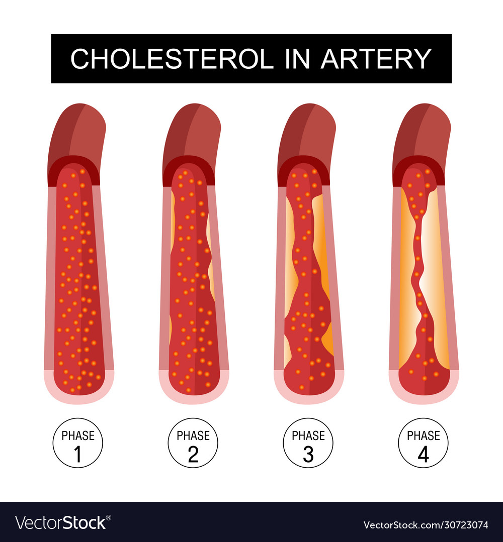 Cholesterol in artery health risk design