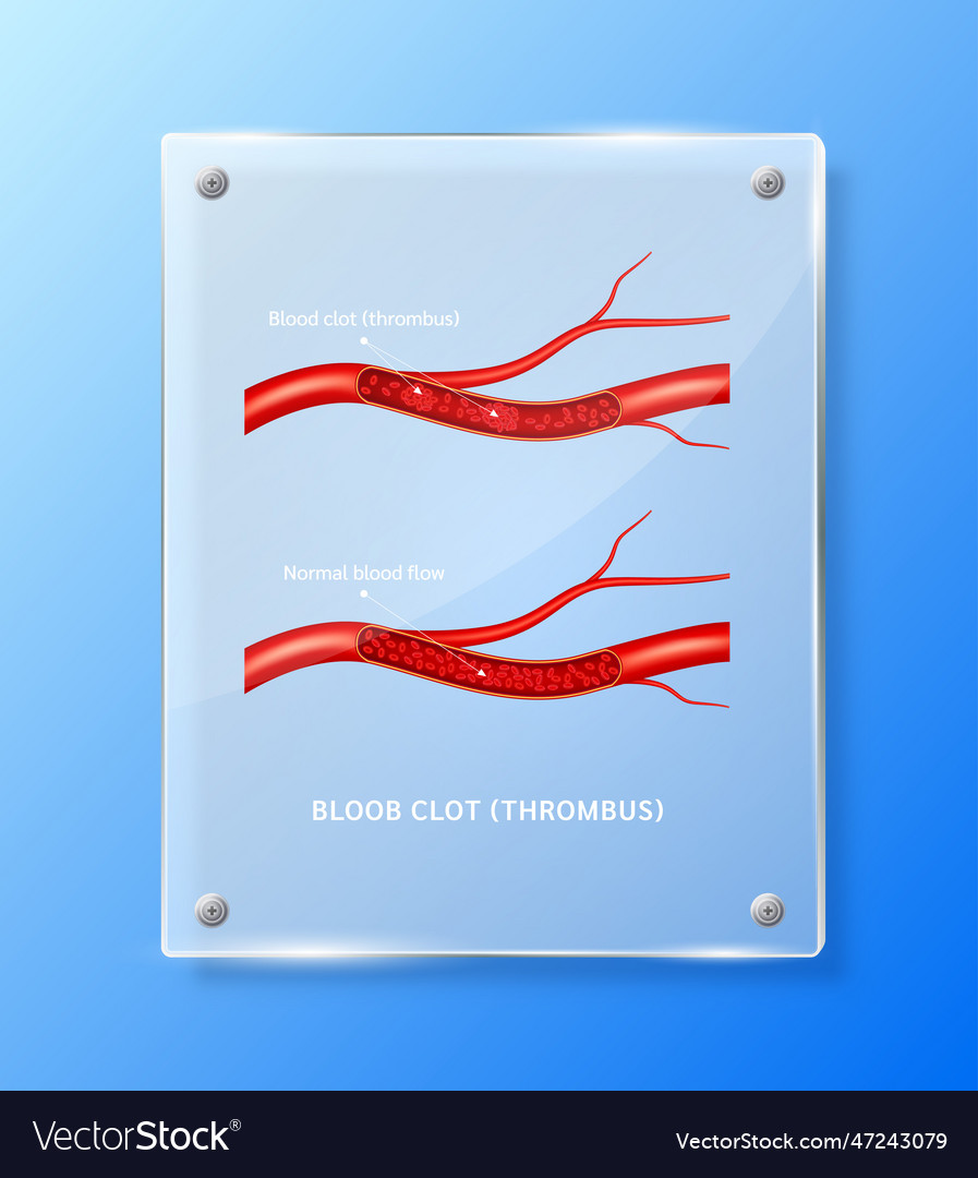 Blood clot thrombus in human