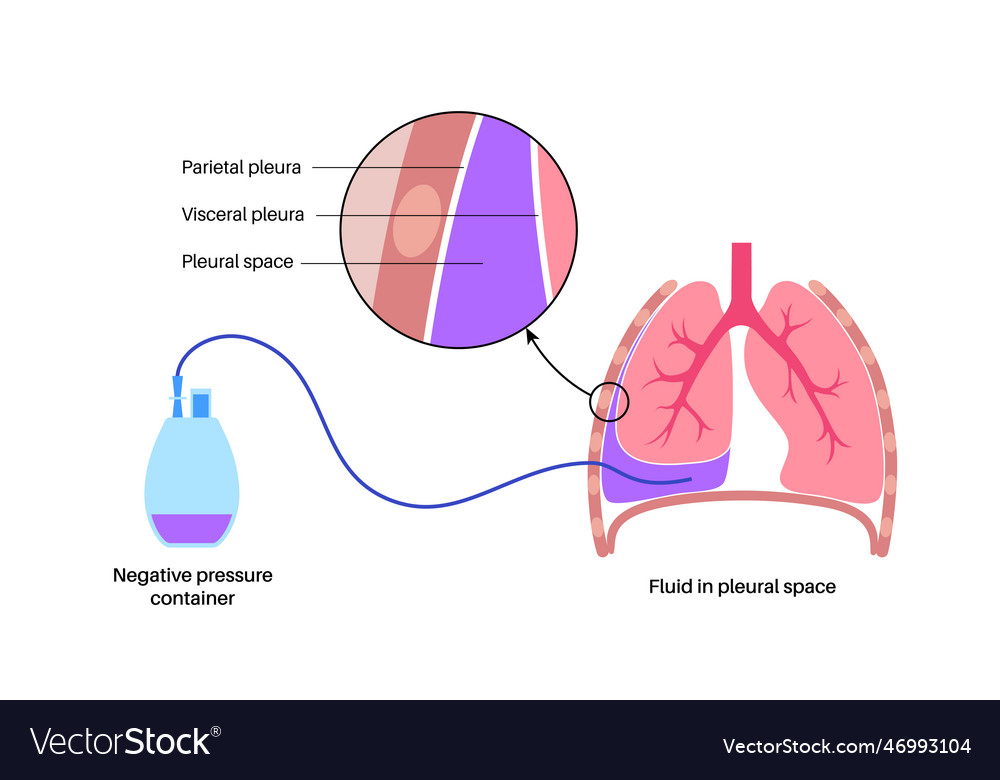 Tunneled pleural catheter