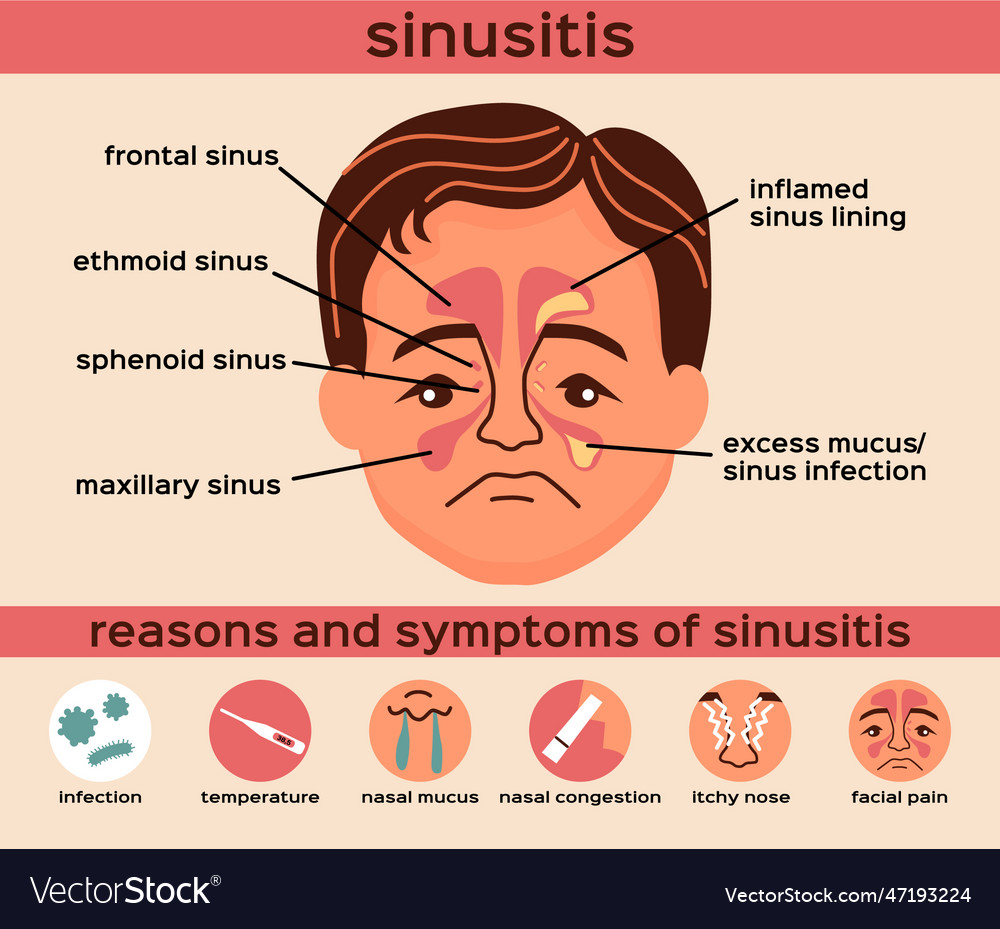 Sinusitis flat infographics Royalty Free Vector Image