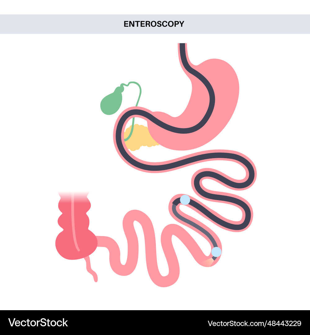 Double balloon enteroscopy Royalty Free Vector Image