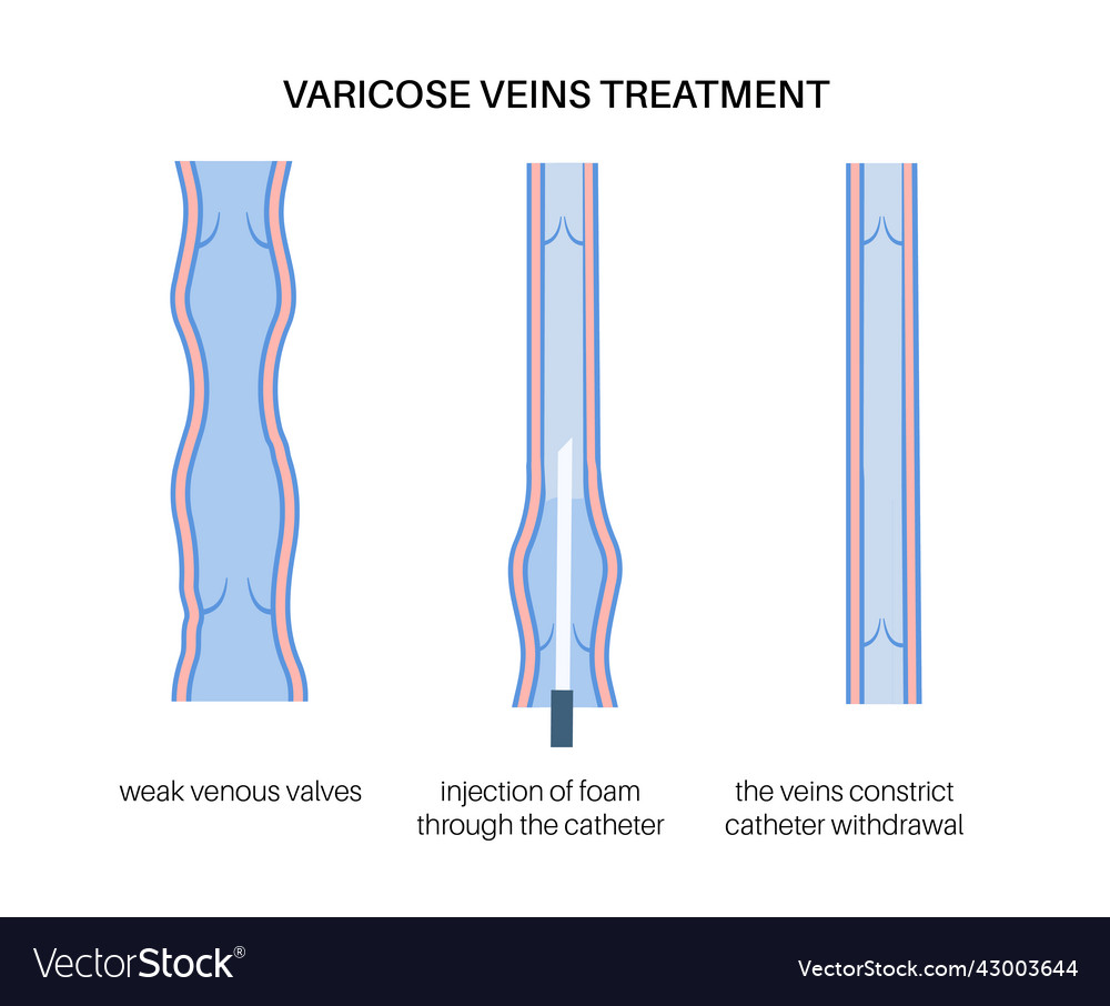 Varicose Injektionsverfahren