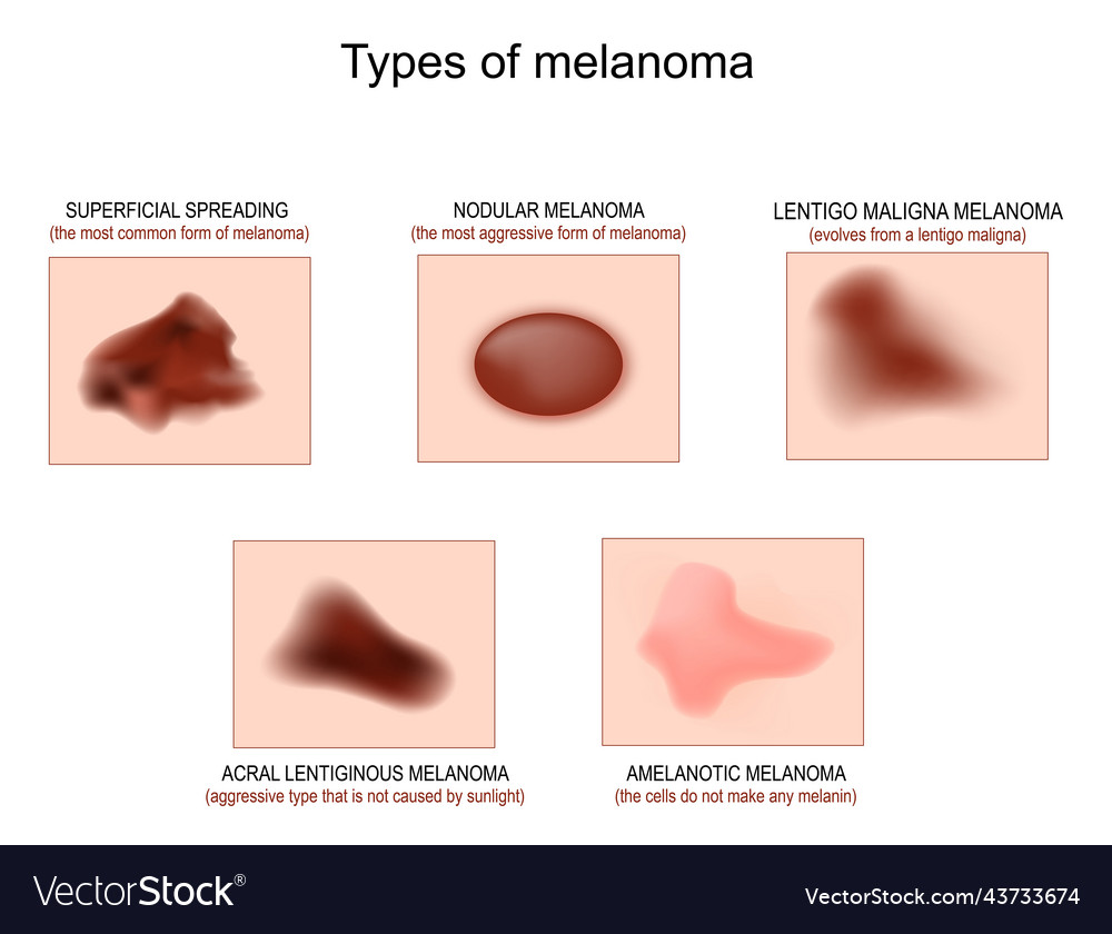 Types of melanoma Royalty Free Vector Image - VectorStock