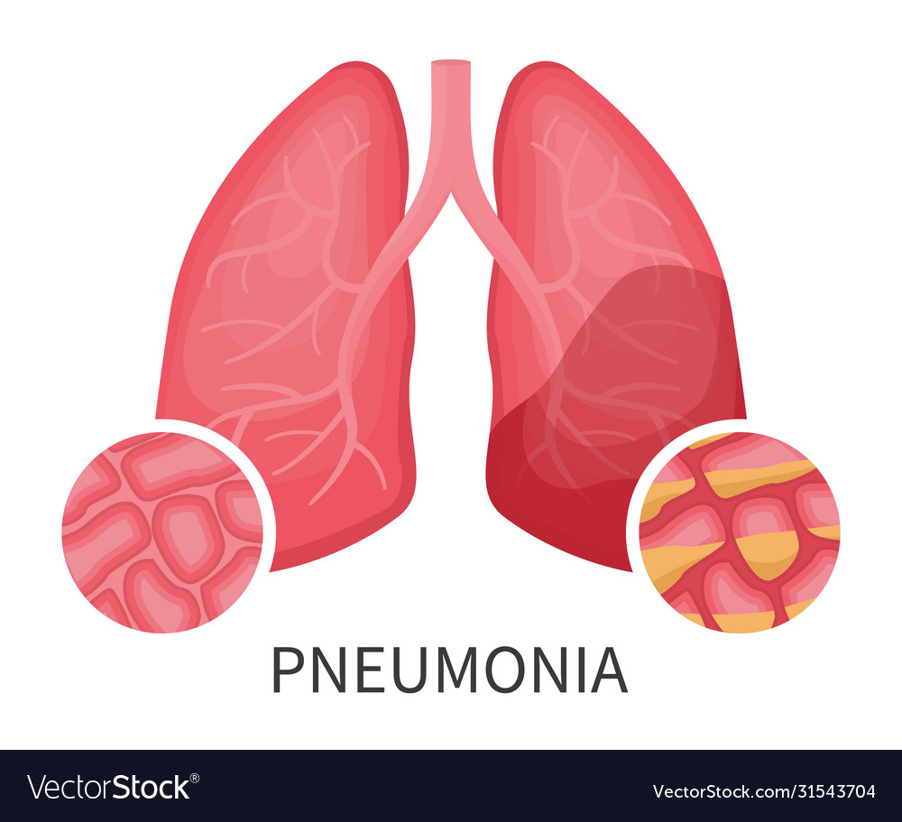 Male Character Symptoms Treatment Pneumonia Vector Stock