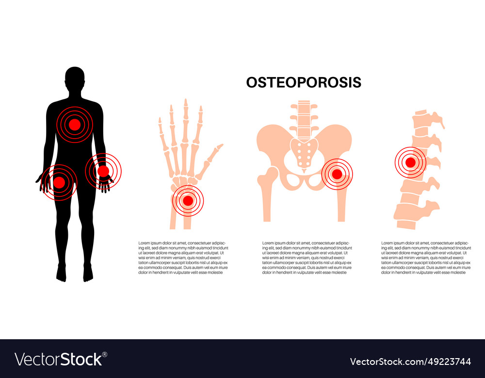 Osteoporosis medical poster Royalty Free Vector Image