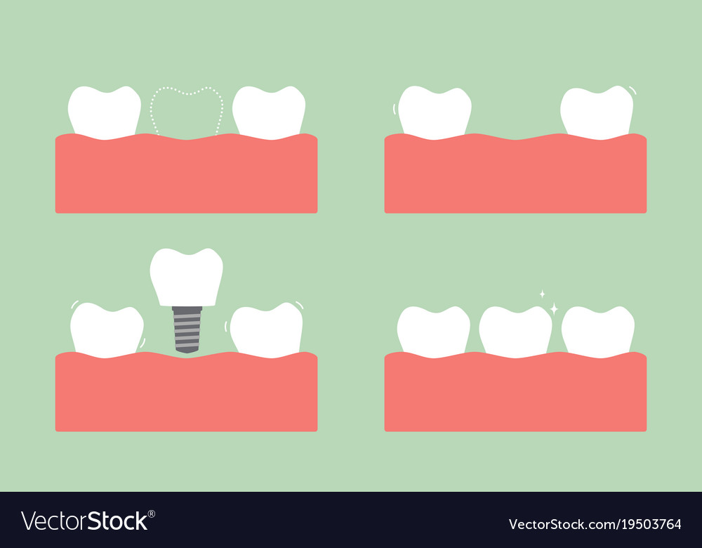 Step of caries to dental implant with crown