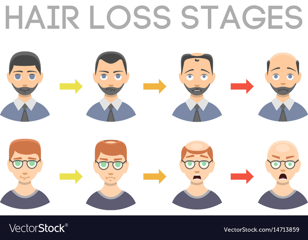 Information Chart Of Hair Loss Stages Types Of Vector Image