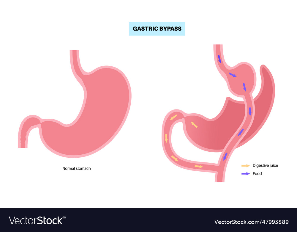 Gastric bypass surgery Royalty Free Vector Image