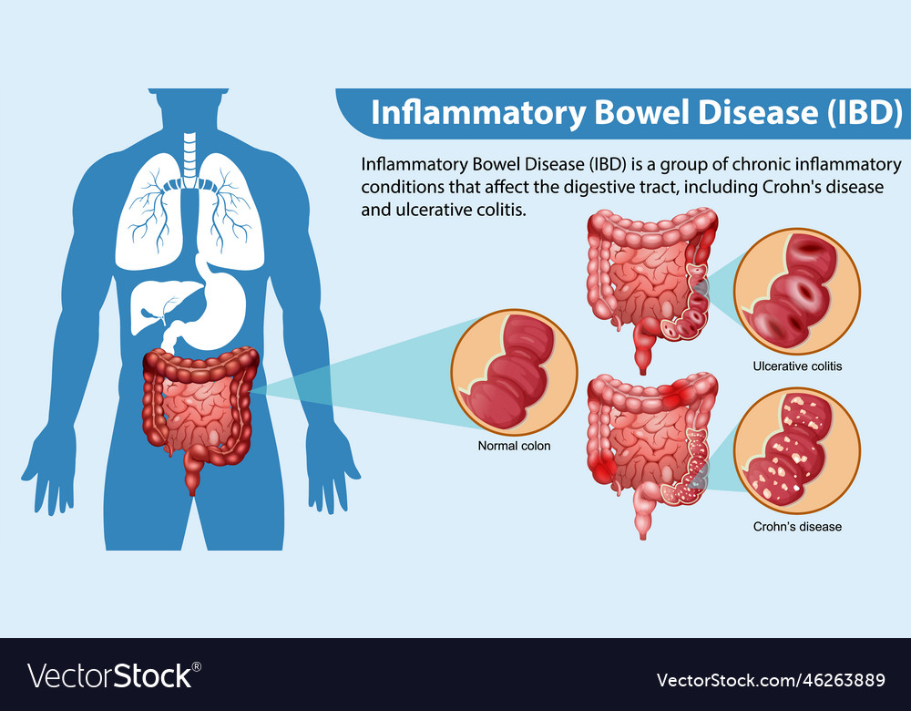 Inflammatory bowel disease ibd infographic Vector Image