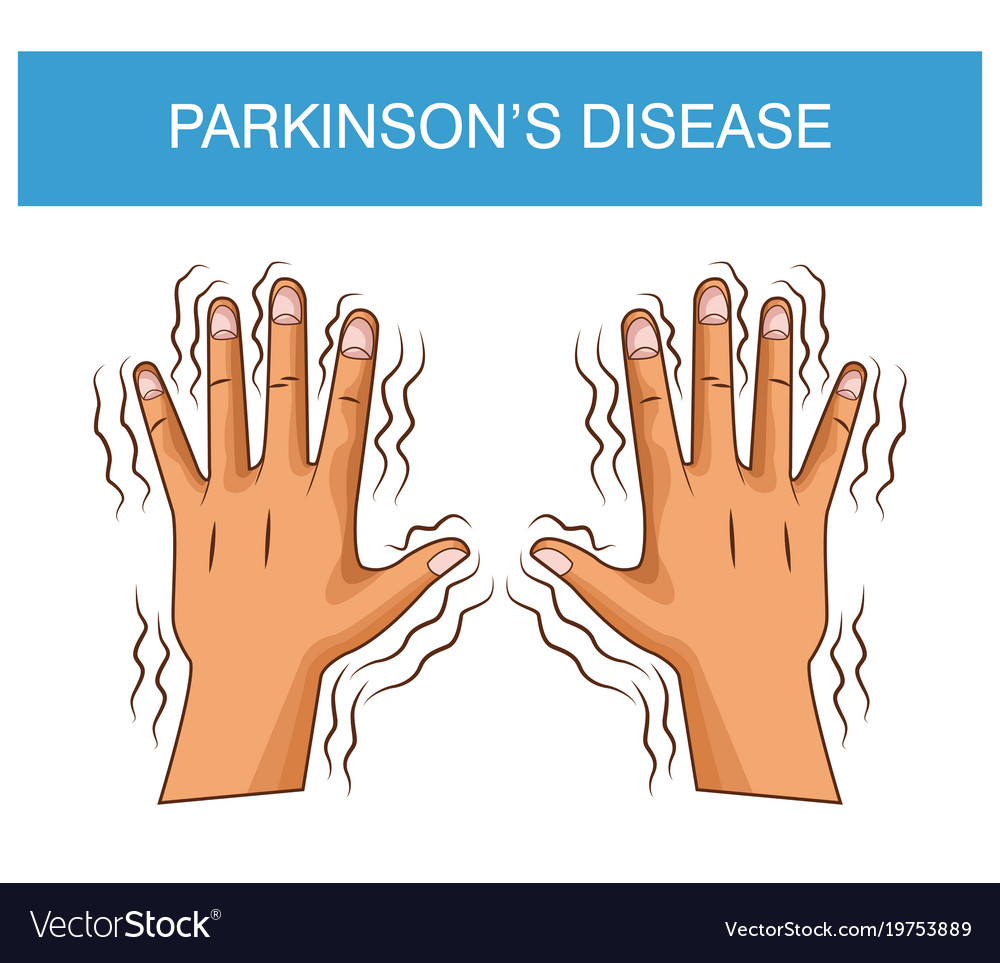 Parkinsons Disease Cartoon Royalty Free Vector Image 5953