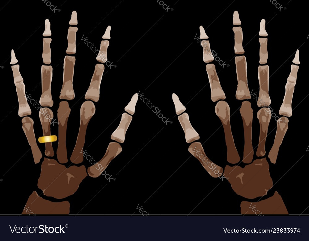 Hand bones