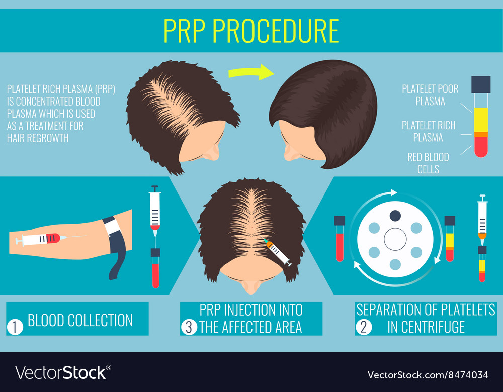 Platelet rich plasma procedure for a woman Vector Image